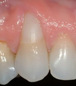 Before Periodontal Plastic surgery