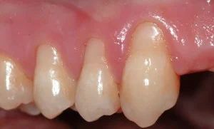 Before Periodontal Plastic surgery