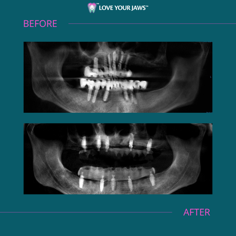 Before and After Dental Implants