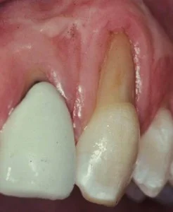 Before Periodontal Plastic surgery