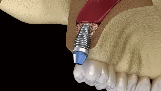 Bone Grafting