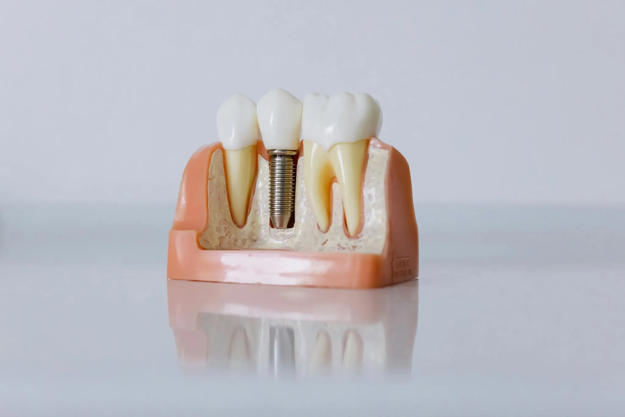 Restore Your Smile with Dental Implants at Love Your Jaws Surgery Center