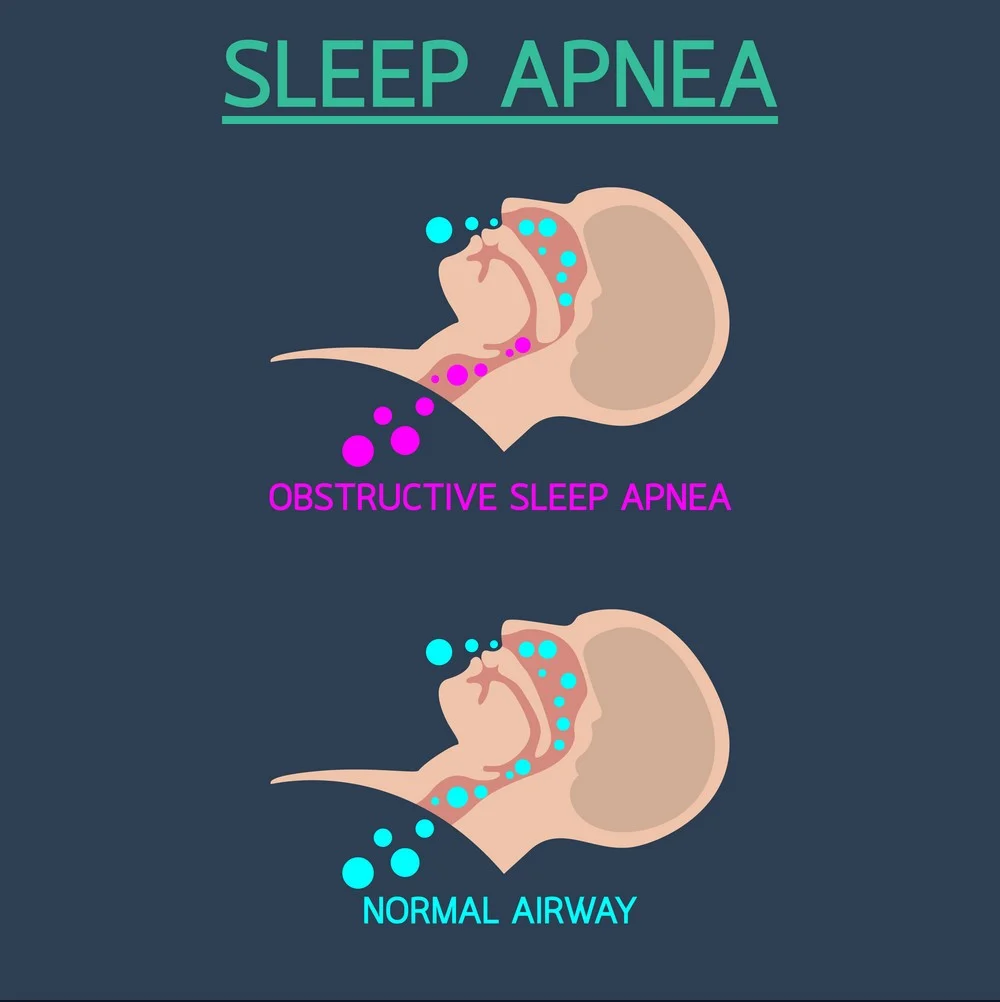 Understanding sleep apnea and how we can help