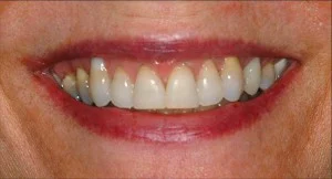 Front view of before Periodontal Plastic surgery