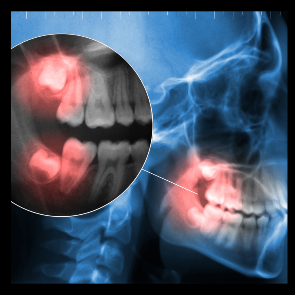 Why is it important to remove wisdom teeth?