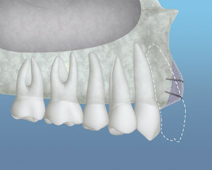 Bone Grafting for Dental Implants