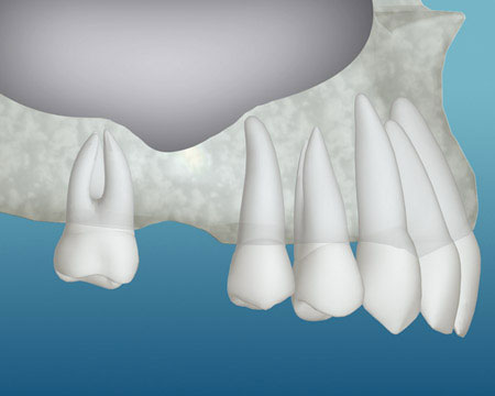 Bone Grafting for Dental Implants