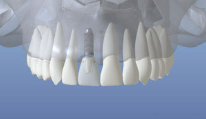 Dental Implants