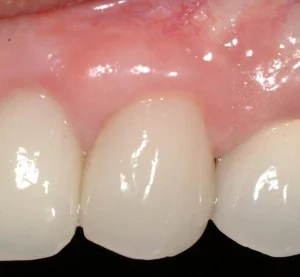 .Combleted results of surgery for implants