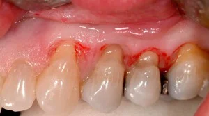 Exposed teeth and recessive gums in patient mouth