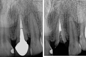 X-ray image of planning for Implant Surgery