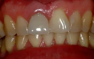 Full view of patient's teeth prior to implant surgery treatment