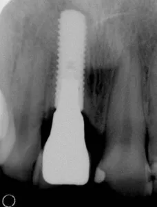 Single tooth implant x-ray image