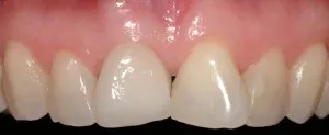 Inversed front two teeth positioning