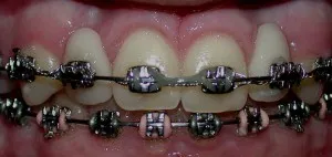 Before with braces with visible gum loss