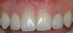 After braces off and gum restoration 