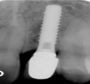 Example of completed implant surgery, x-ray alternate view