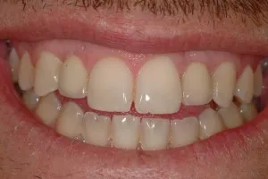 Completed treatment after implant surgery