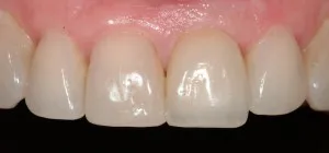 Completed top row of teeth after surgery