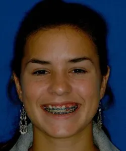Image of patient before treatment with braces and missing teeth