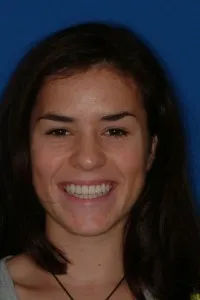 Image of patient after treatment with braces and missing teeth