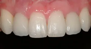 Close up of top row patient teeth after implant surgery