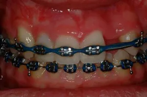 Before image of patient with braces and missing teeth