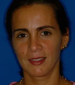 After image of patient once braces are removed