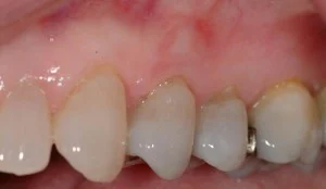 [After periodontal plastic surgery to restore gums