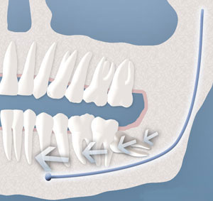 An illustration of teeth crowding caused by a wisdom tooth