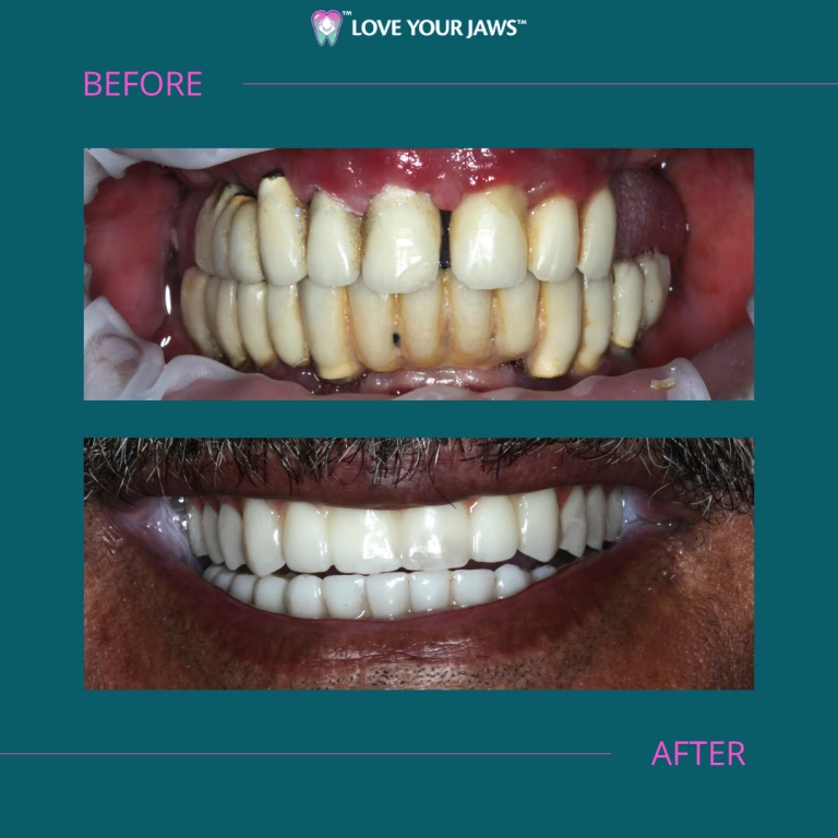 Before and After Dental Implants