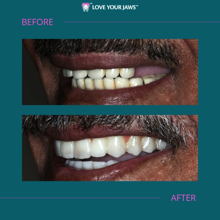 Before and After Dental Implants